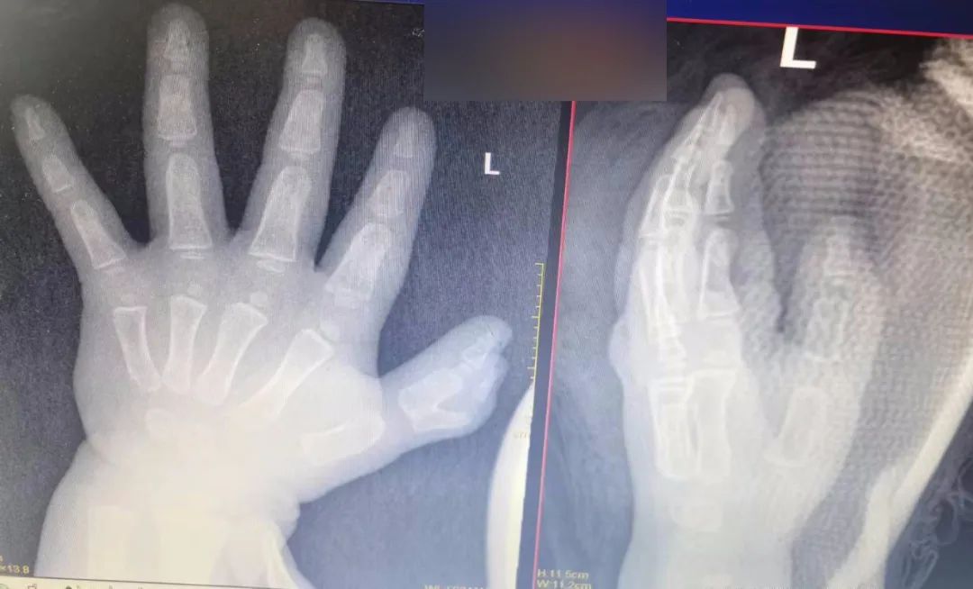 1 岁女宝天生六指形似「蟹钳」，父母心急如焚