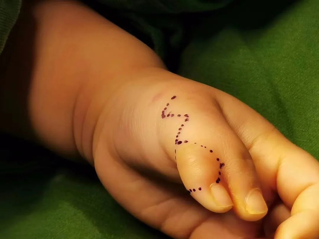 1 岁女宝天生六指形似「蟹钳」，父母心急如焚