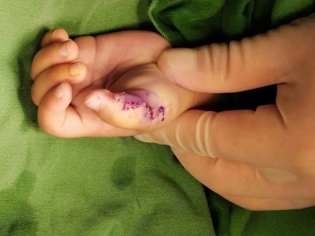 1 岁女宝天生六指形似「蟹钳」，父母心急如焚