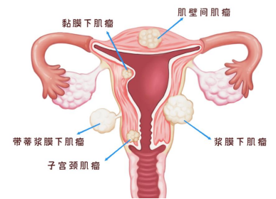 少女子宫肌瘤是什么原因导致的？