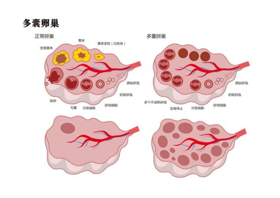 多囊卵巢能怀上孩子吗？