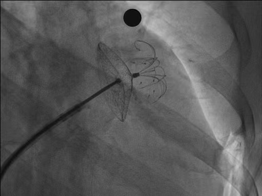 了解一下! 堵住心脏「小耳朵」 预防脑中风——经皮左心耳封堵术