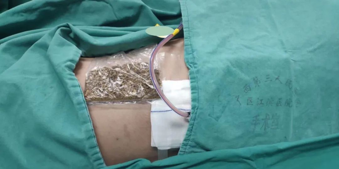 34 克！这些小石头，让他疼了一年多……