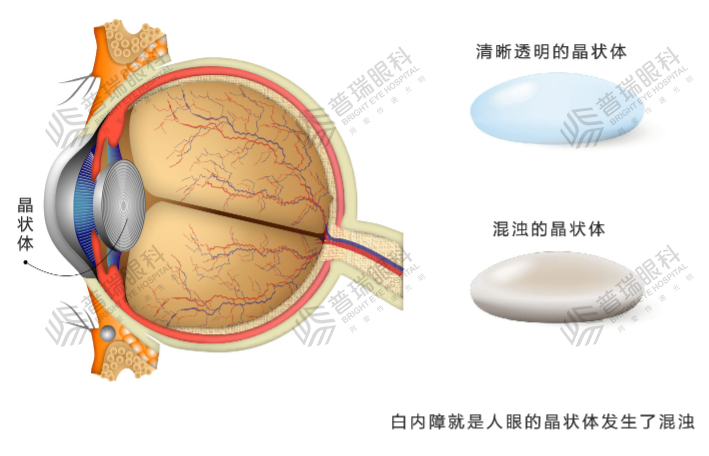 年纪大了看不清是老花眼？武汉普瑞眼科眼科医生：还有可能是白内障