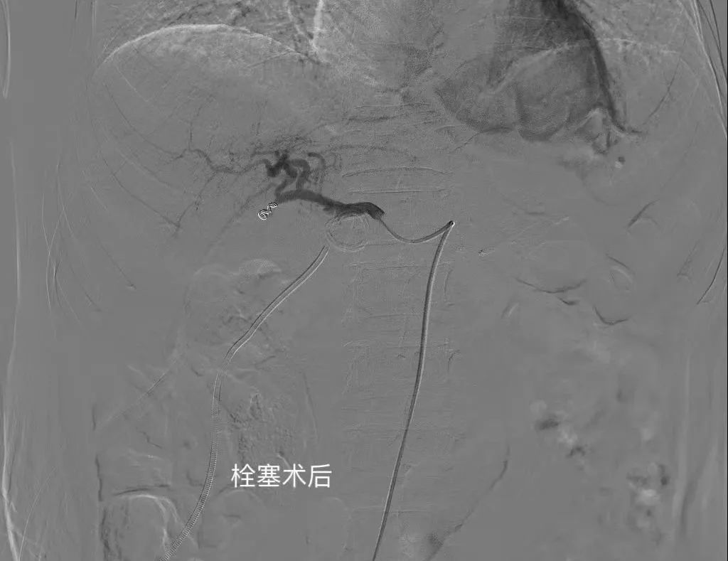 6 旬老人胰腺癌术后大出血，血管介入 2 小时上演「生死时速」