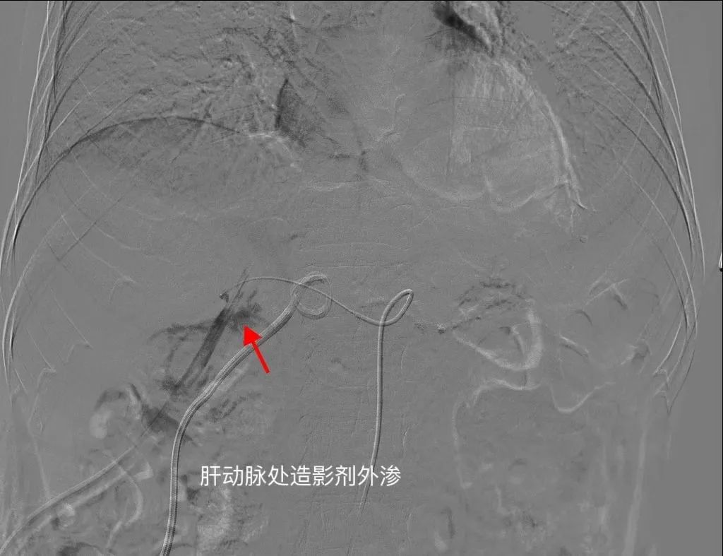 6 旬老人胰腺癌术后大出血，血管介入 2 小时上演「生死时速」