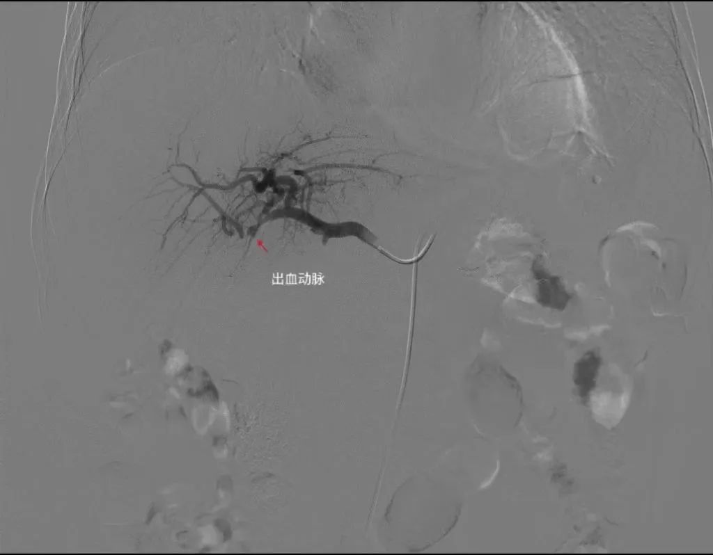 6 旬老人胰腺癌术后大出血，血管介入 2 小时上演「生死时速」