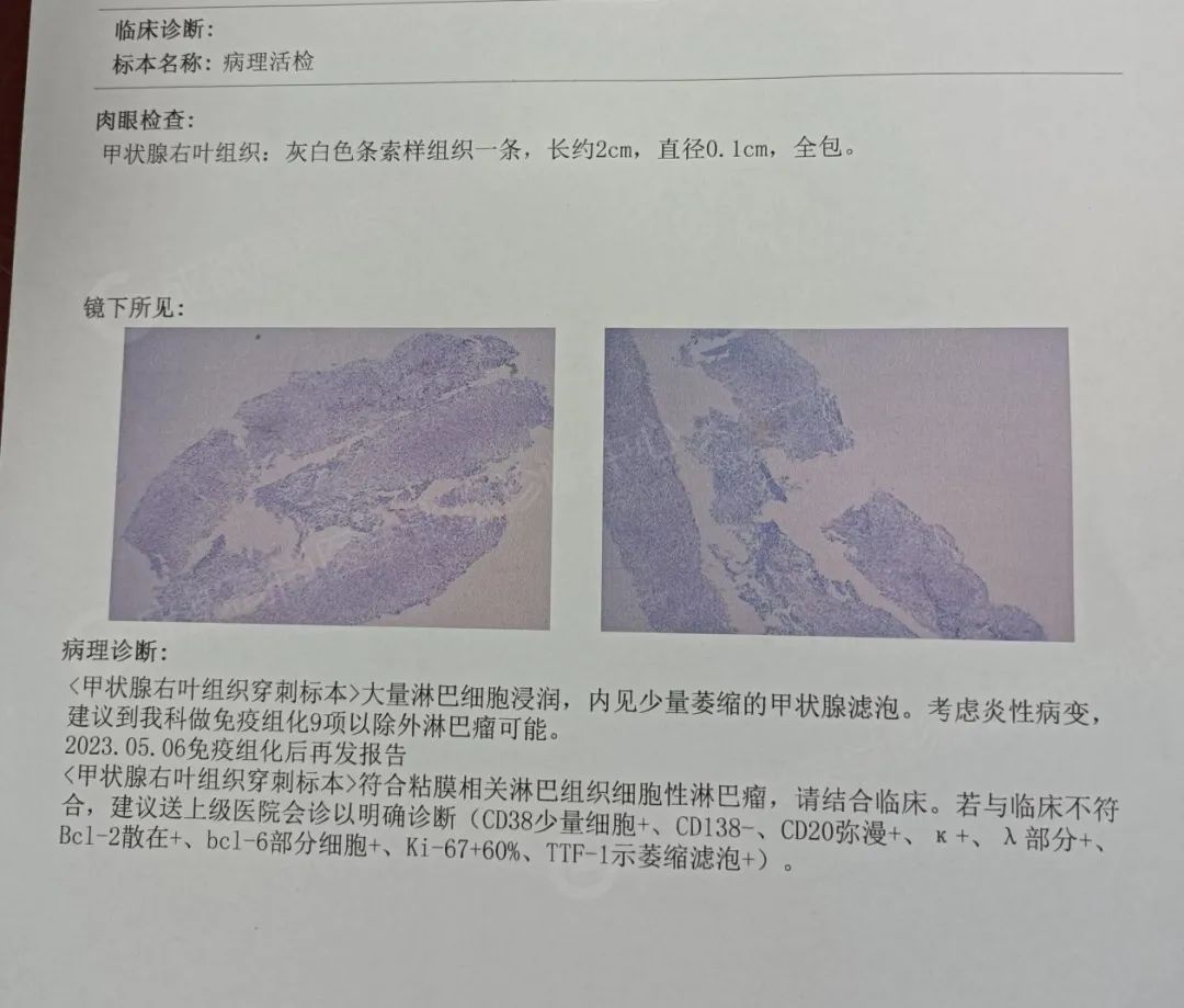 【高尚病例】原发性甲状腺恶性淋巴瘤（PTML）一例