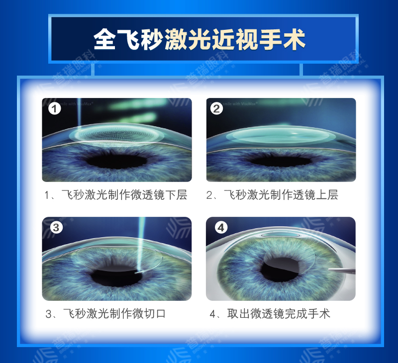 暑期摘镜总动员：近视手术有哪些类型？武汉普瑞眼科医生来科普