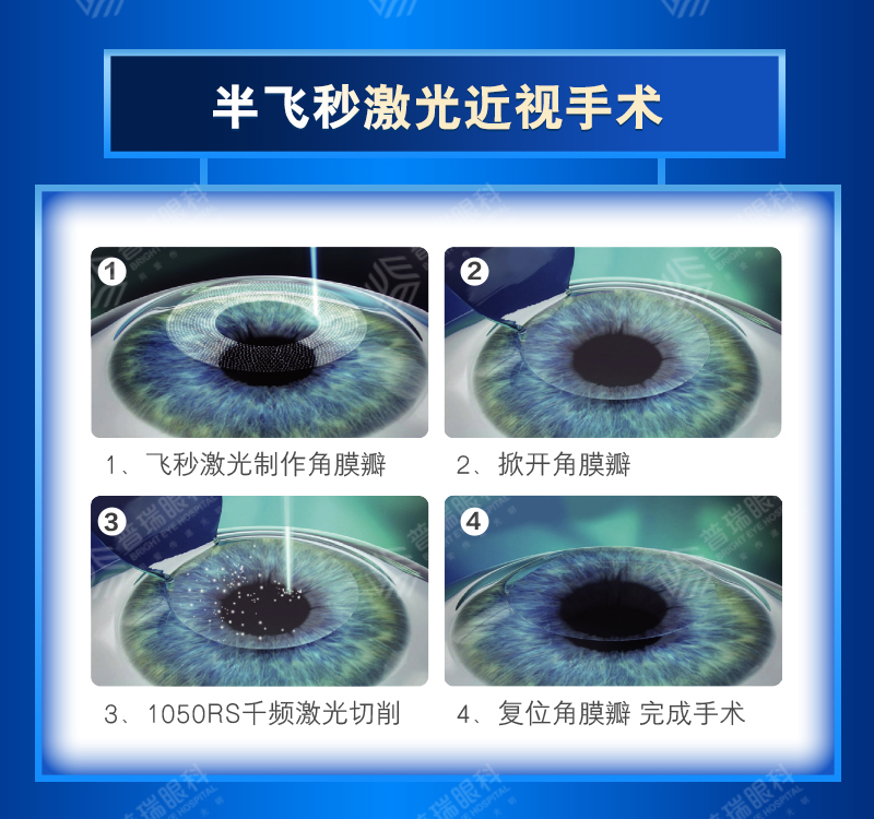 暑期摘镜总动员：近视手术有哪些类型？武汉普瑞眼科医生来科普