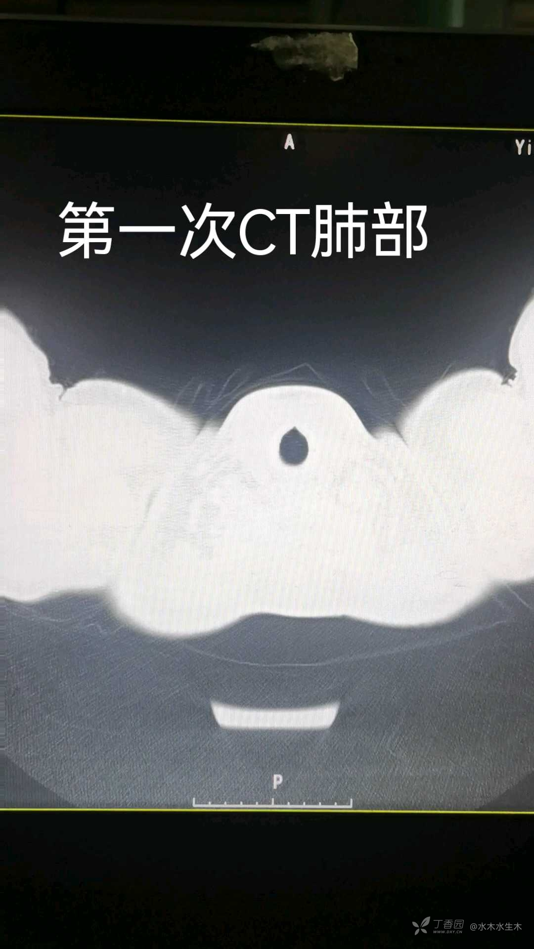 一眼洞穿系列之——细菌人