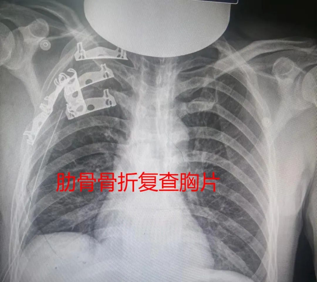 微创新「镜界」——宁城县中心医院心胸外科开展胸腔镜微创肋骨骨折切开复位内固定术