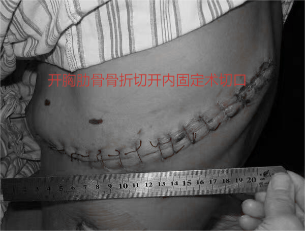 微创新「镜界」——宁城县中心医院心胸外科开展胸腔镜微创肋骨骨折切开复位内固定术