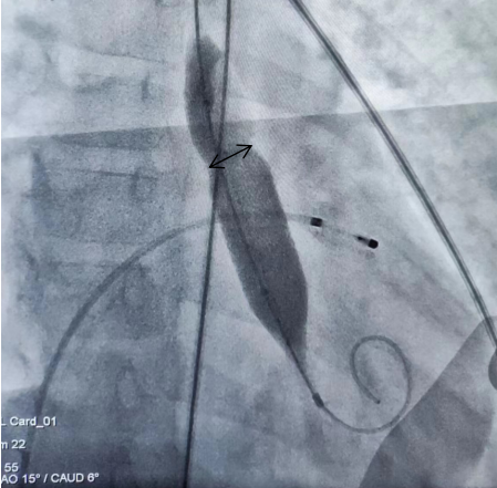 7 岁女孩心门狭窄危及生命！心脏大血管外科主动脉瓣球囊扩张术为她「扩心门」
