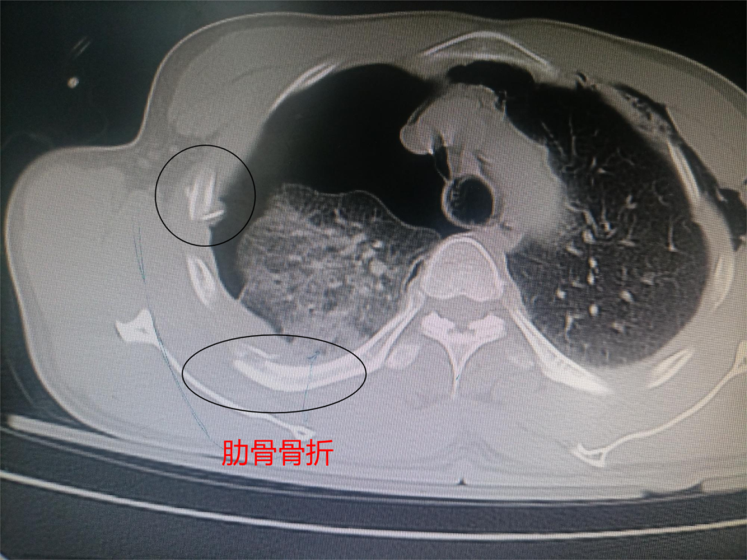 肋弓骨折图片