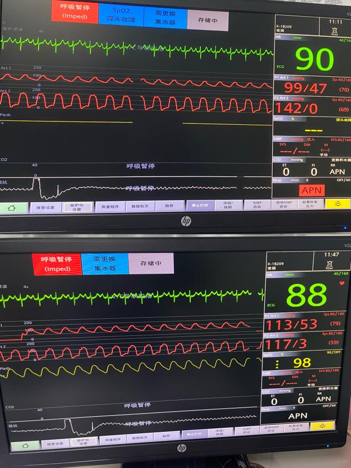 广西中医药大学一附院何贵新团队顺利完成一例极重度狭窄、三叶瓣、横位心 TAVR 手术