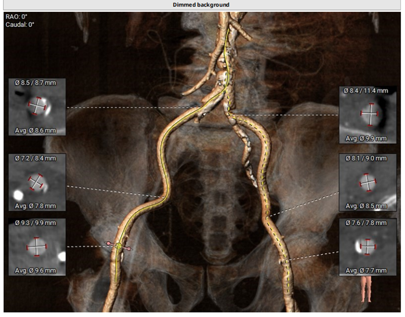 广西中医药大学一附院何贵新团队顺利完成一例极重度狭窄、三叶瓣、横位心 TAVR 手术