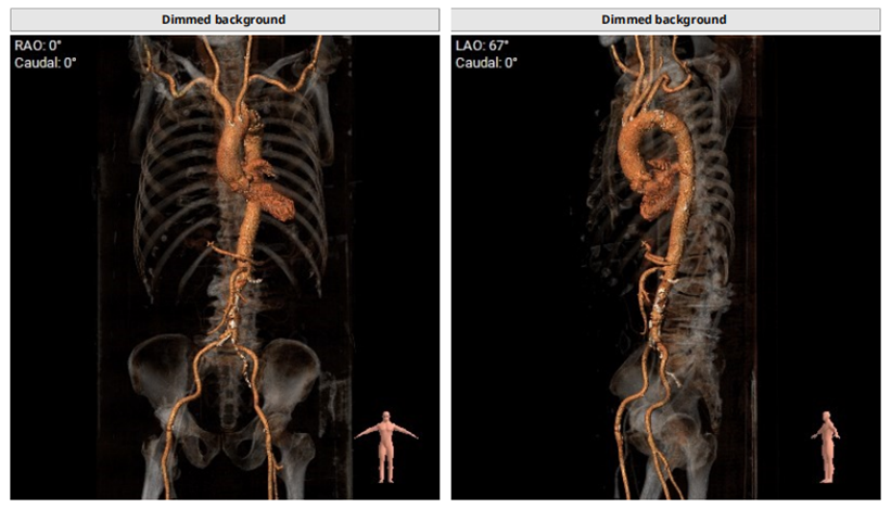 广西中医药大学一附院何贵新团队顺利完成一例极重度狭窄、三叶瓣、横位心 TAVR 手术