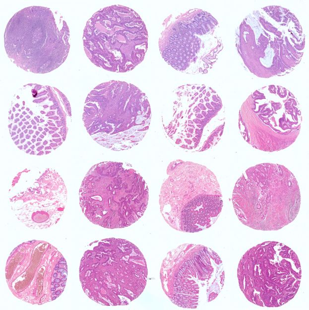 卵巢癌生存期组织芯片
