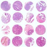 卵巢癌预后组织芯片