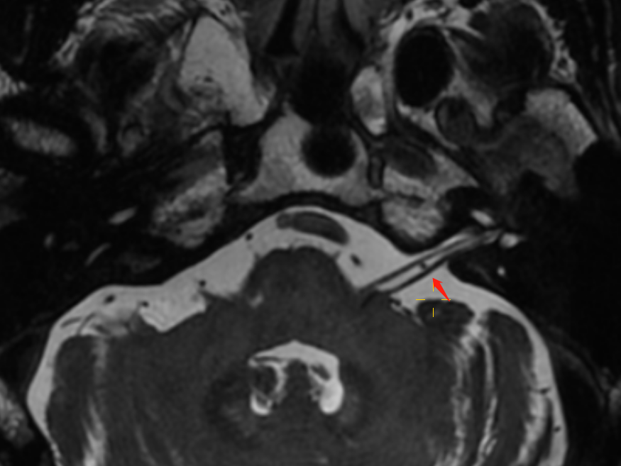 影像专家上阵解疑难，精准击破「美尼尔病」