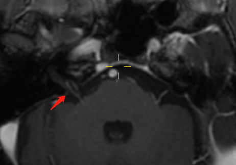 影像专家上阵解疑难，精准击破「美尼尔病」