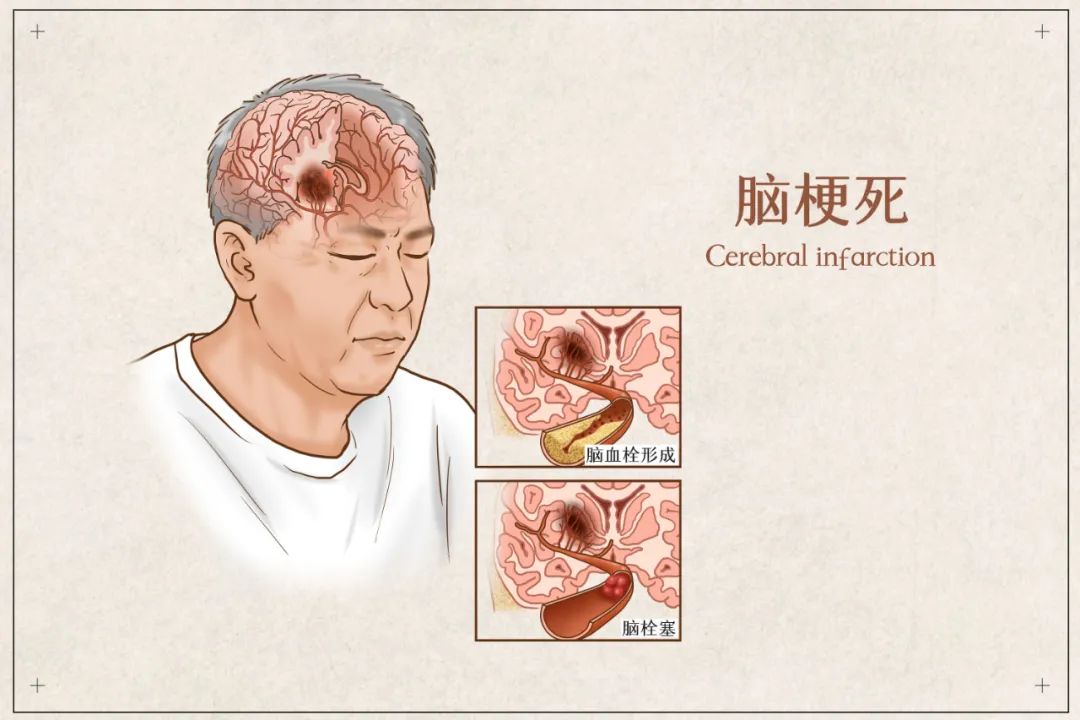 错过「黄金 4.5 小时」 ，脑梗死患者还可辅助高压氧治疗