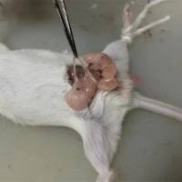 输精管结扎手术