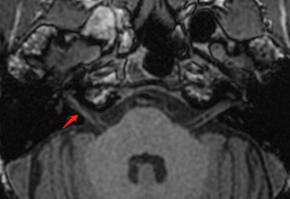 影像专家上阵解疑难，精准击破「美尼尔病」