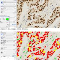 病理定量阳性率分析