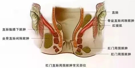 夏天肛周脓肿容易发作，这次真的不能再拖了！