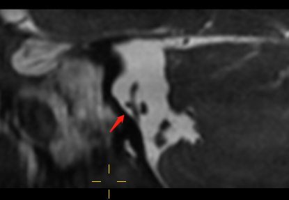 影像专家上阵解疑难，精准击破「美尼尔病」