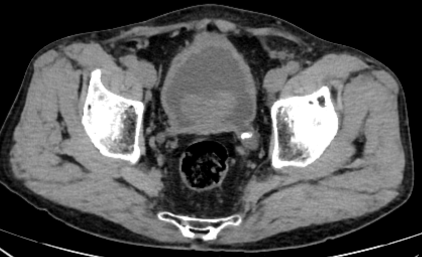 腰痛被误诊？前列腺增生别忽视！