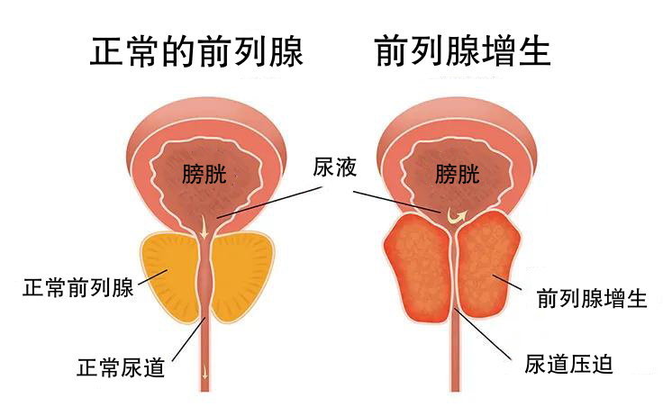 腰痛被误诊？前列腺增生别忽视！