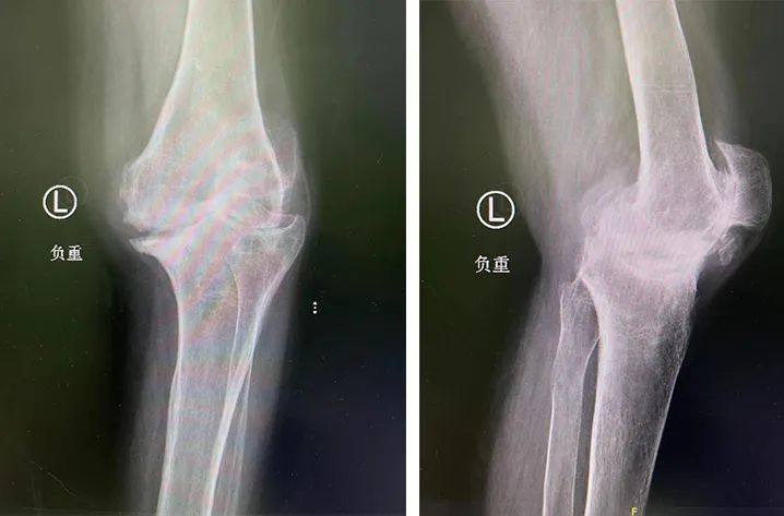 当关节置换机器人对上「不死的癌症」,这场关于类风湿性关节炎的战役究竟谁能胜出?