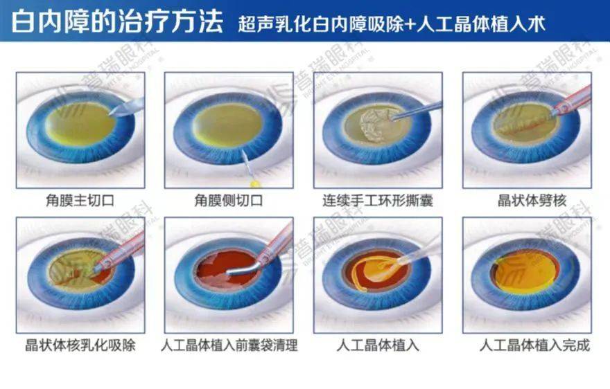 得了白内障,可以滴眼药水治疗吗?武汉普瑞眼科医院医生为您解答