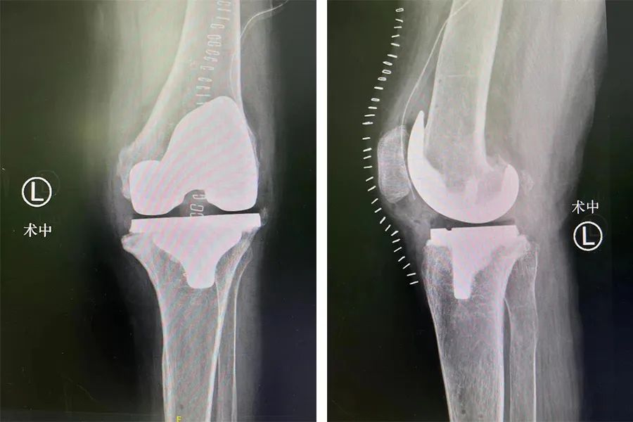 当关节置换机器人对上「不死的癌症」,这场关于类风湿性关节炎的战役究竟谁能胜出?