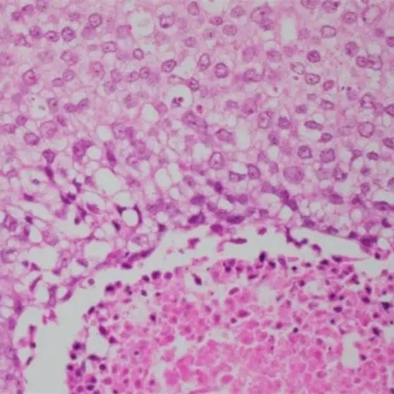裸鼠乳腺癌原位瘤