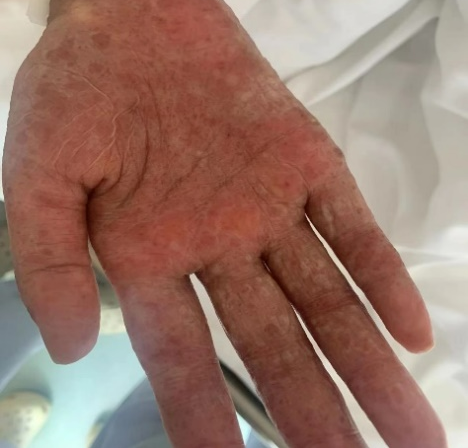 道培科普 | 造血干细胞移植后皮肤 GVHD 治疗与护理