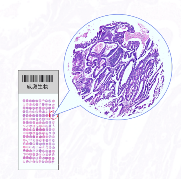 卵巢癌生存期组织芯片