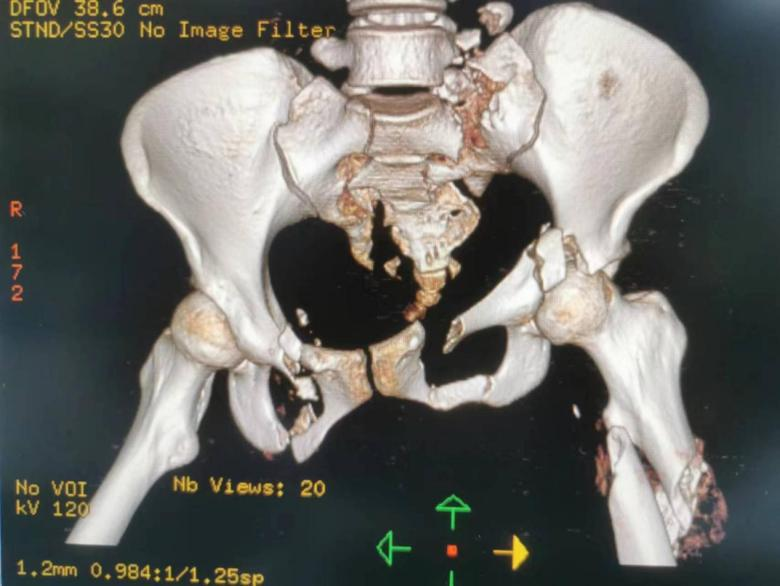 20 岁女孩高空坠落险弃疗,萨米医疗骨科团队齐心协力为其成功手术