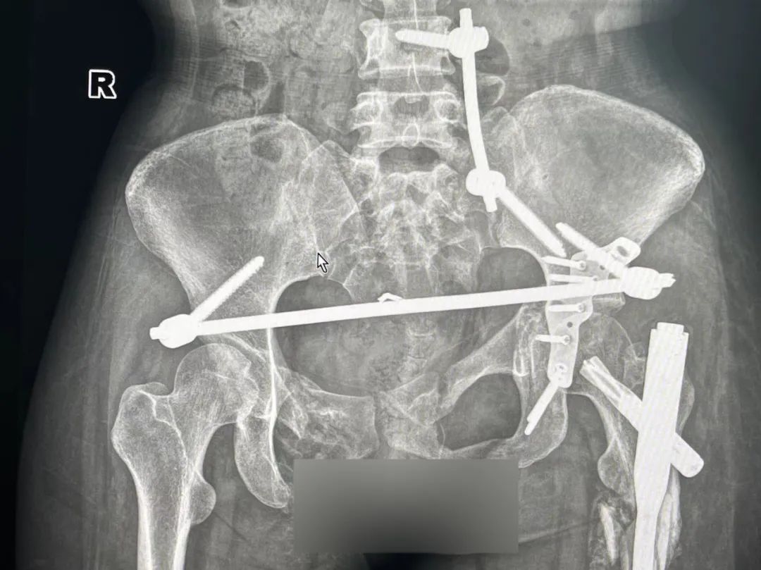 20 岁女孩高空坠落险弃疗,萨米医疗骨科团队齐心协力为其成功手术