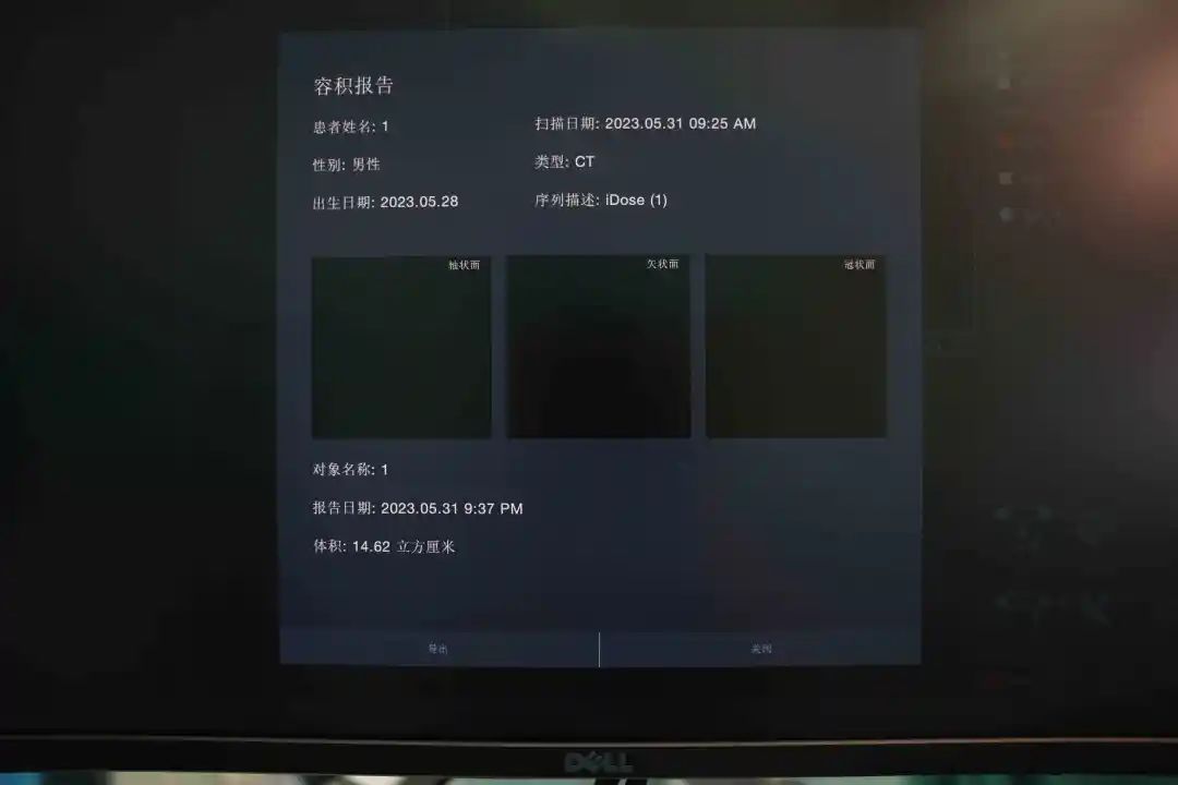 西北妇女儿童医院成功完成『世界首例』机器人辅助治疗早产儿脑出血