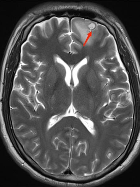 不明原因抽搐、狂躁，原来是虫子「钻进」了脑袋！