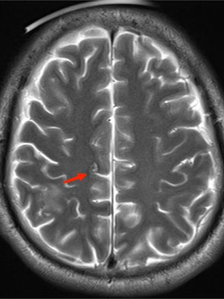 不明原因抽搐、狂躁，原来是虫子「钻进」了脑袋！