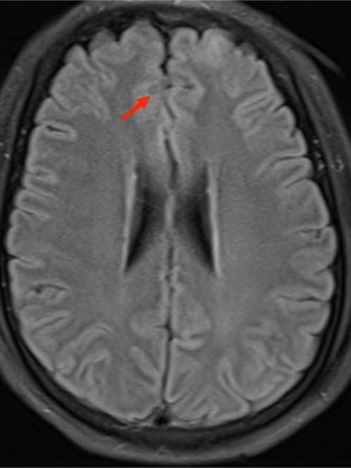 不明原因抽搐、狂躁，原来是虫子「钻进」了脑袋！