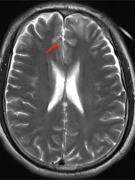 不明原因抽搐、狂躁，原来是虫子「钻进」了脑袋！