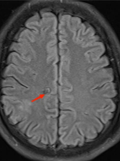 不明原因抽搐、狂躁，原来是虫子「钻进」了脑袋！