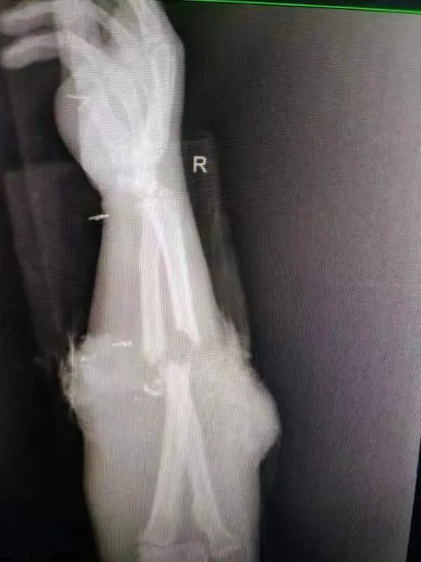 武汉区域两院骨科协同,断臂成功再植!