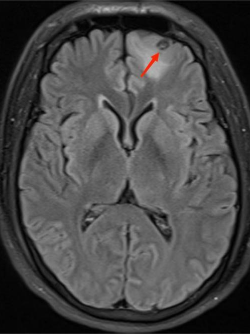 不明原因抽搐、狂躁，原来是虫子「钻进」了脑袋！